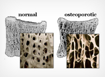 Osteoporosis